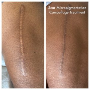 Scar Micropigmentation